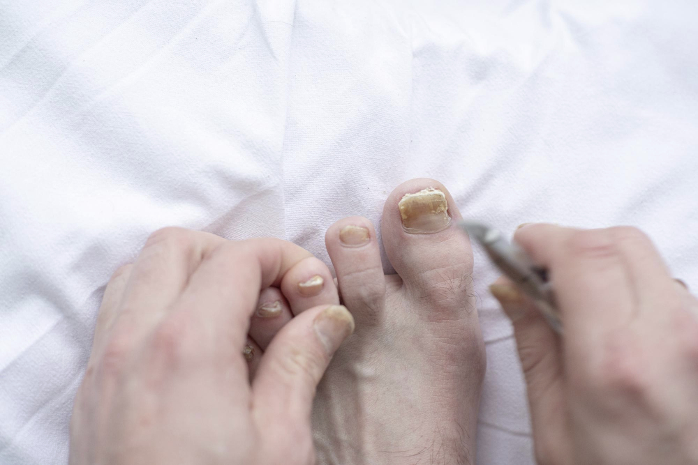 Onychomycosis-Treatment-img