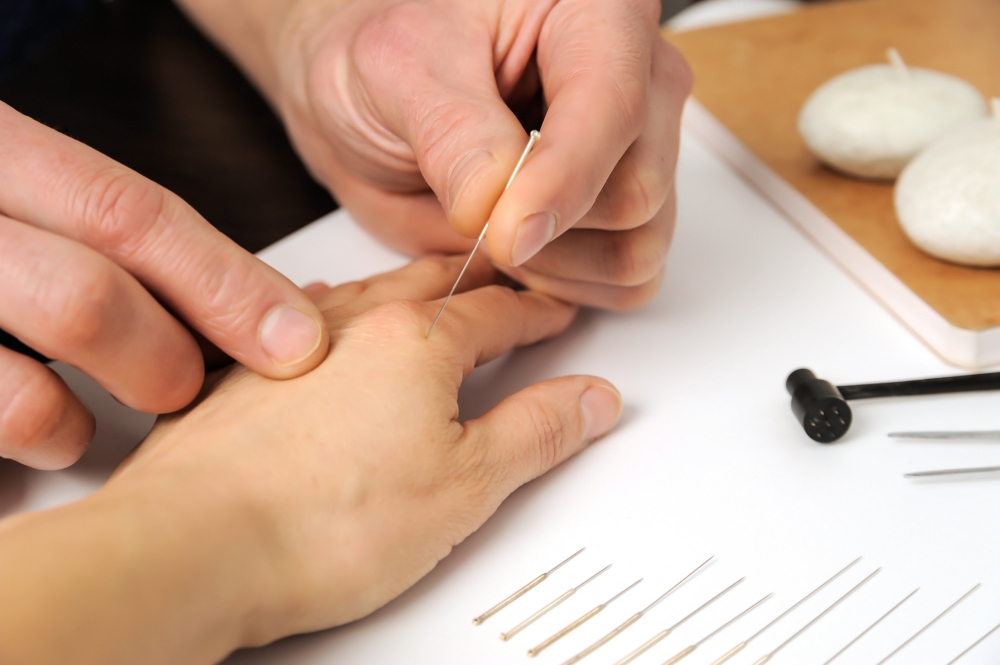 Acupuncture
