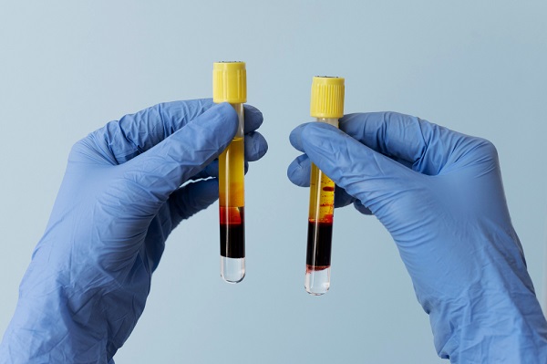 Platelet-Rich Plasma therapy Ontario