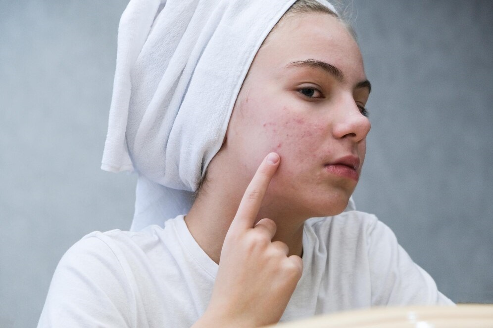 Acne & Acne Scar Treatments in Pickering, ON By by Vitaluxe Medi Spa