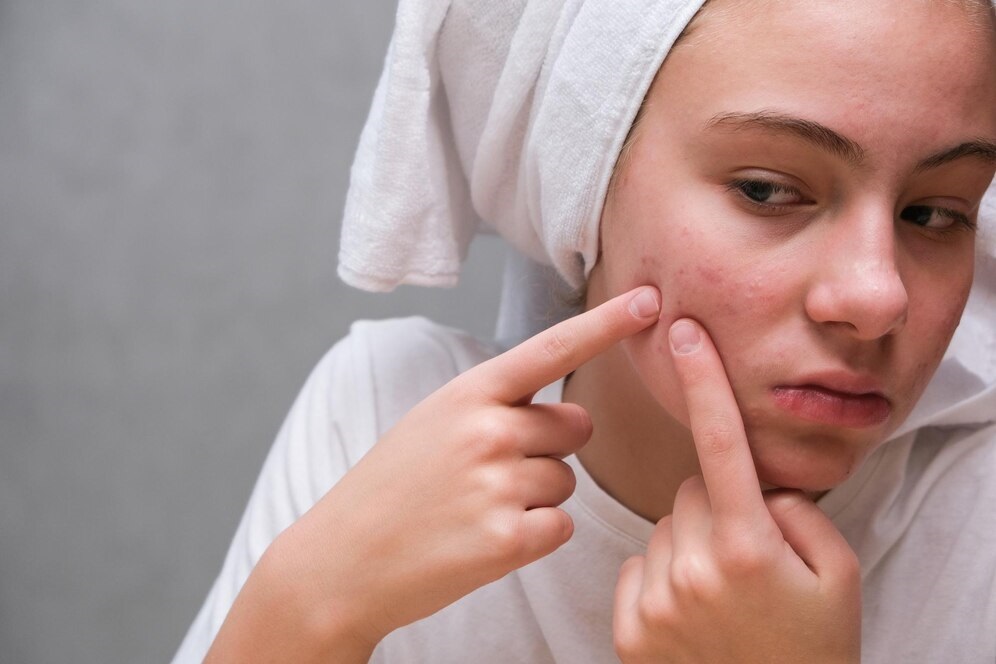 Acne & Acne Scar Treatments in Pickering, ON By by Vitaluxe Medi Spa