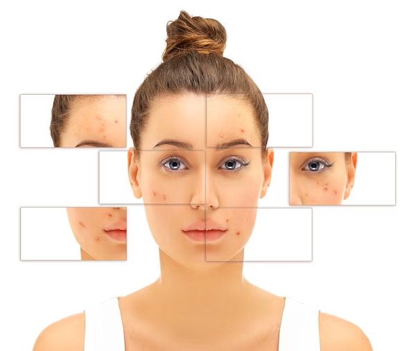 Acne & Acne Scar Treatments in Pickering, ON By by Vitaluxe Medi Spa