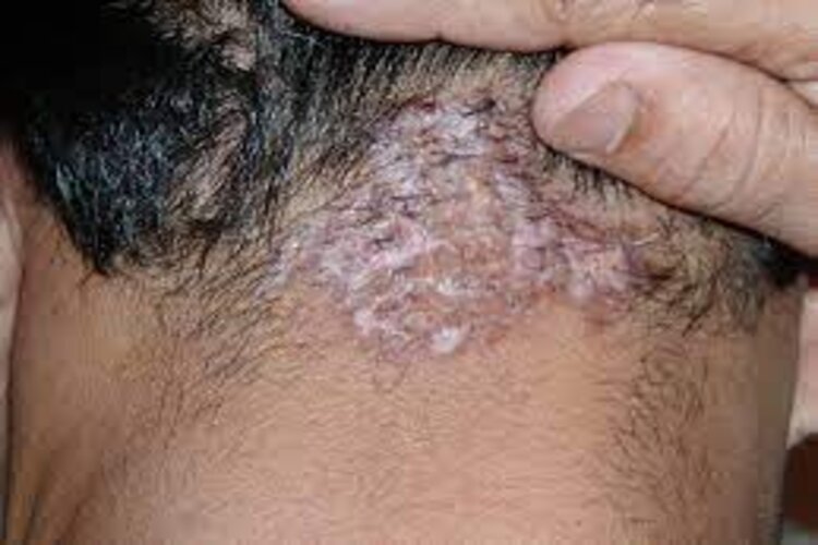 Acne Keloidalis Nuchae Treatment in Pickering, ON By by Vitaluxe Medi Spa