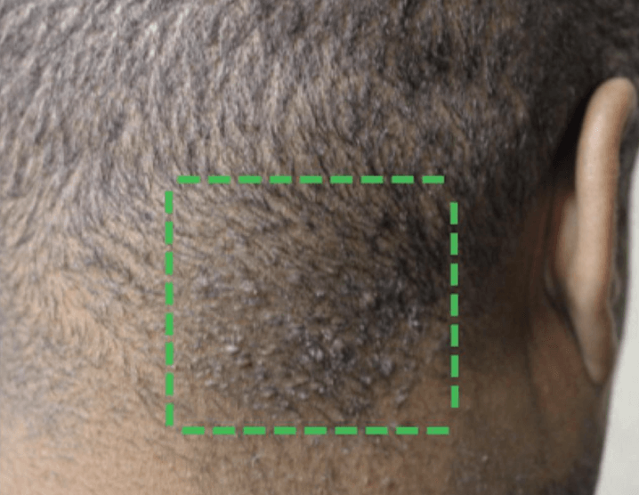 Acne Keloidalis Nuchae Treatment in Pickering, ON By by Vitaluxe Medi Spa