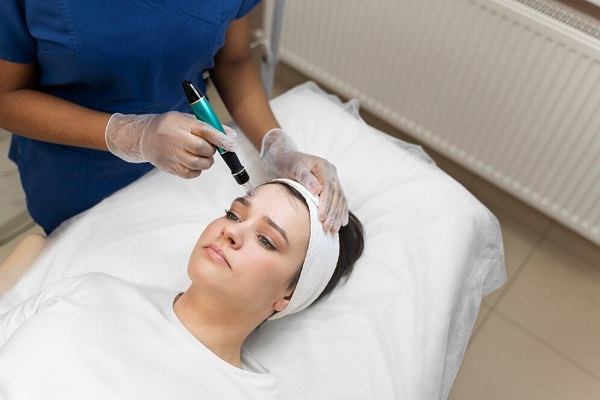 Microlaser Peel Treatment in Pickering, ON by Vitaluxe Medi Spa