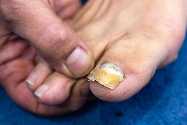 Onychomycosis Treatment in Pickering, ON By by Vitaluxe Medi Spa