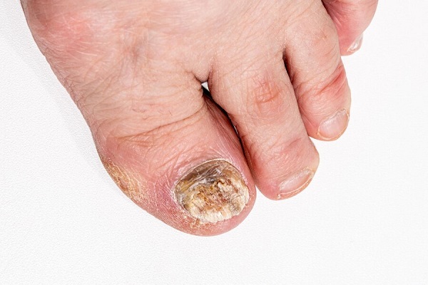 Onychomycosis Treatment in Pickering, ON By by Vitaluxe Medi Spa