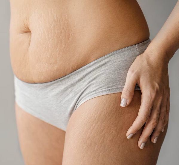 Scars Treatment in Pickering, ON By by Vitaluxe Medi Spa